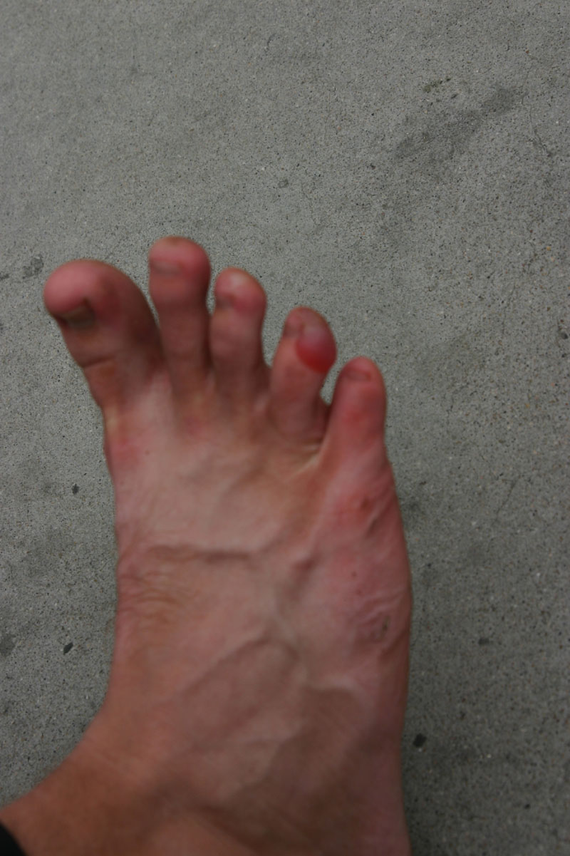 Aleks' 6th toe 02