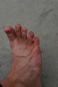 Aleks' 6th toe 02